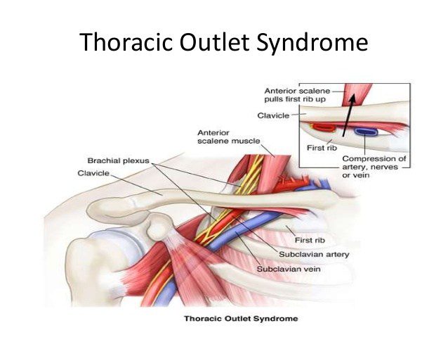 Thoracic Outlet Syndrome (TOS)